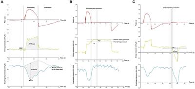 Use of pressure muscle index to predict the contribution of patient’s inspiratory effort during pressure support ventilation: a prospective physiological study